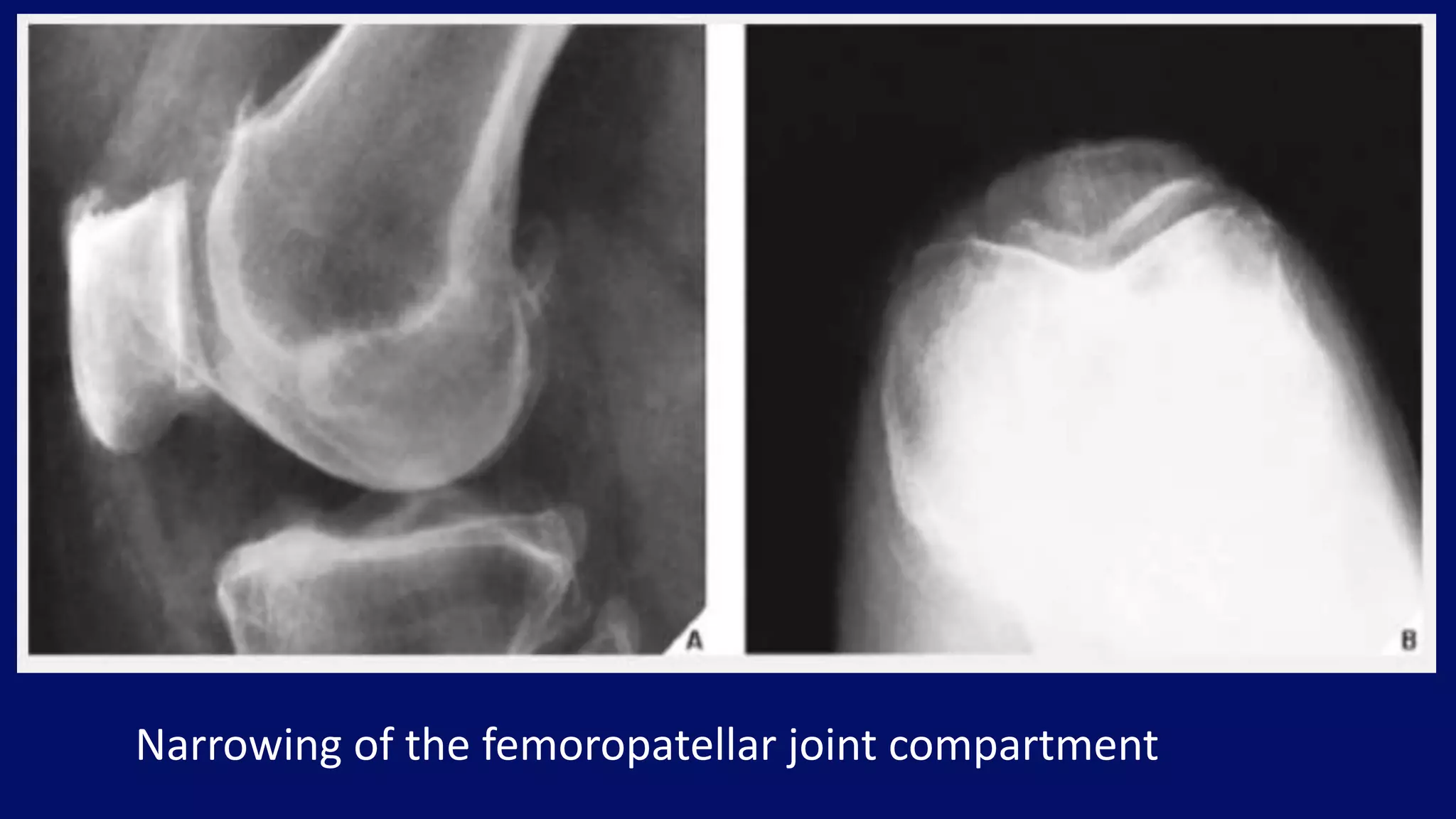 Narrowing of the femoropatellar joint compartment
 