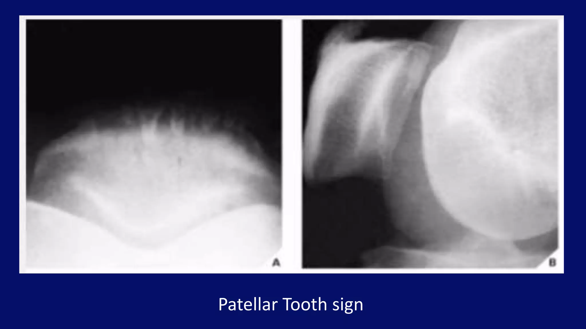 Patellar Tooth sign
 