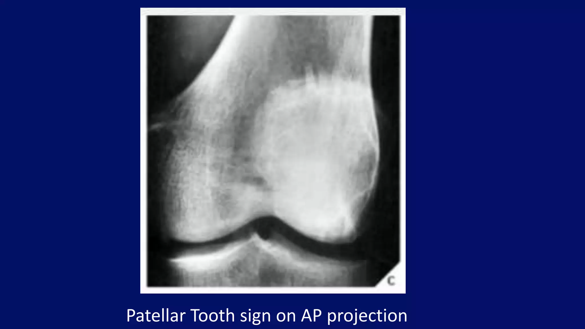 Patellar Tooth sign on AP projection
 