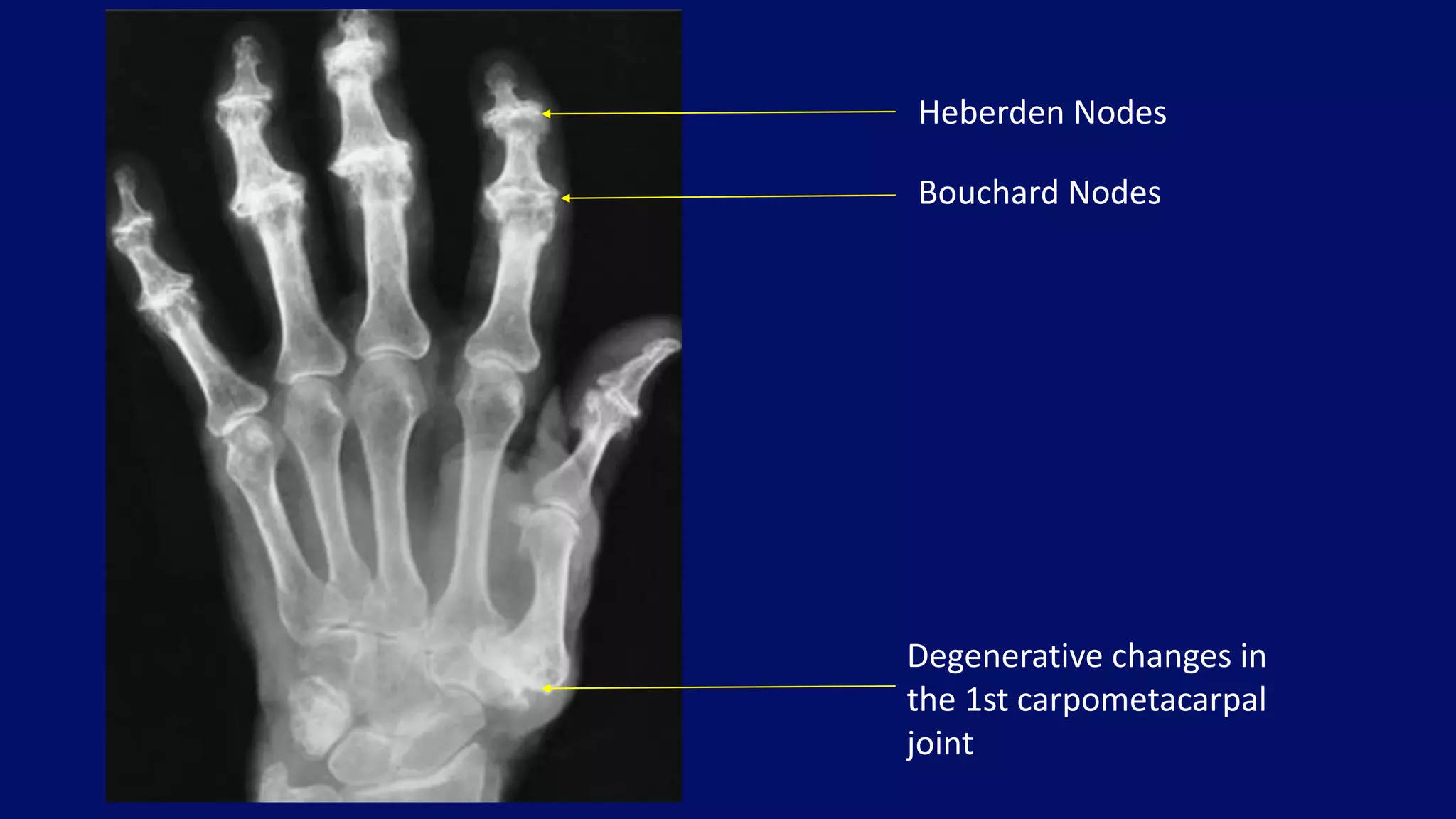 Heberden Nodes
Bouchard Nodes
Degenerative changes in
the 1st carpometacarpal
joint
 