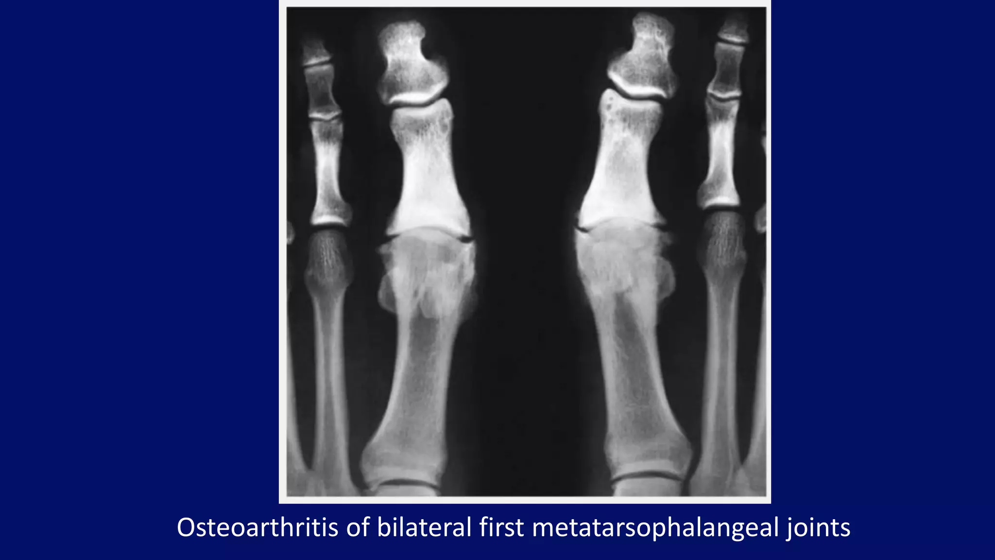 Osteoarthritis of bilateral first metatarsophalangeal joints
 