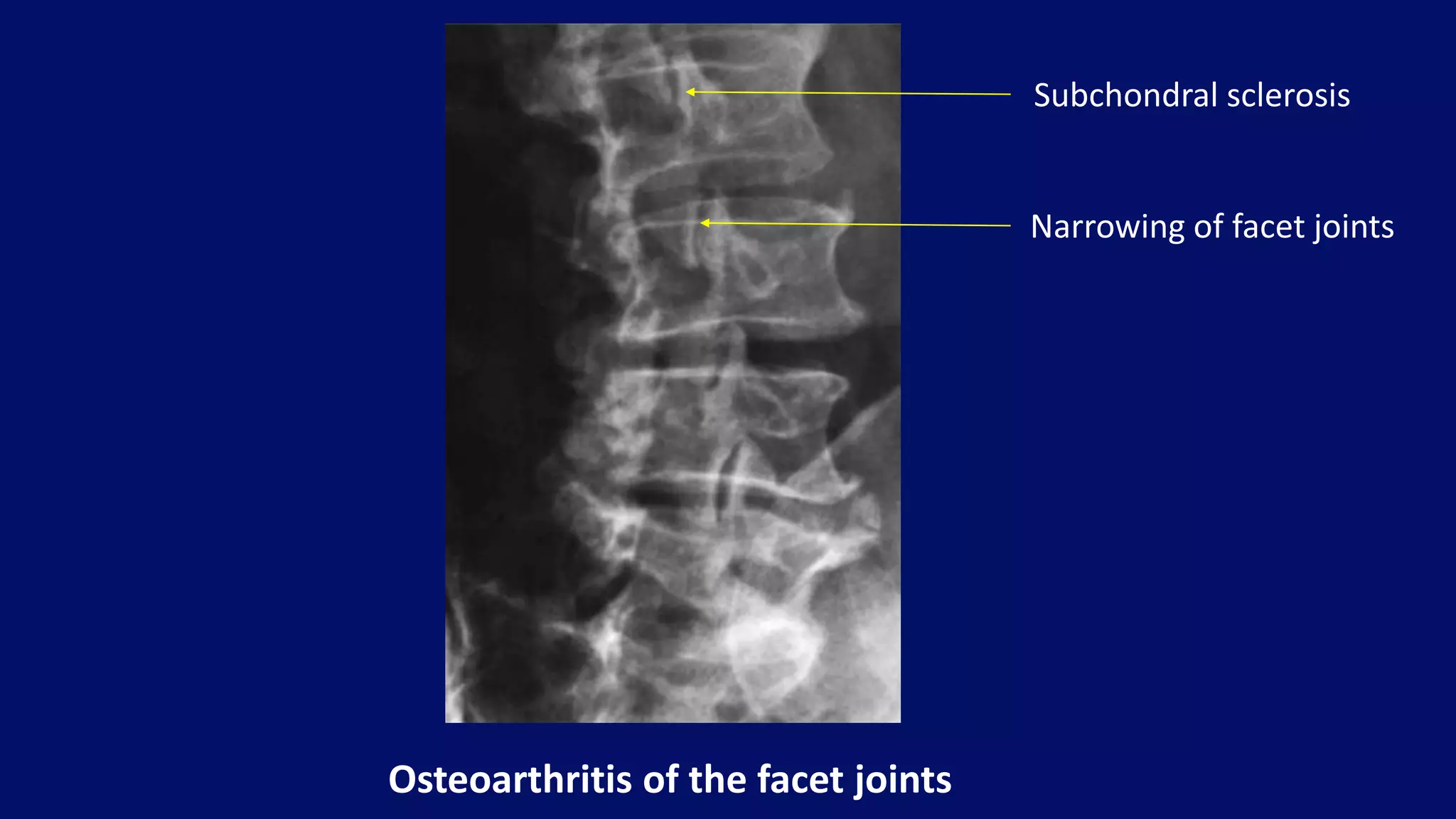 Osteoarthritis of the facet joints
Subchondral sclerosis
Narrowing of facet joints
 