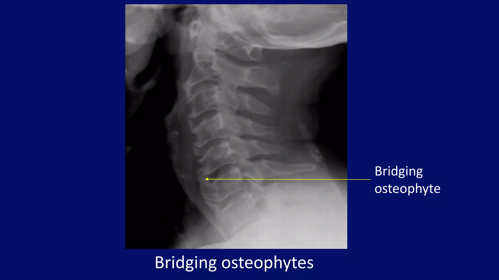 Bridging osteophytes
Bridging
osteophyte
 