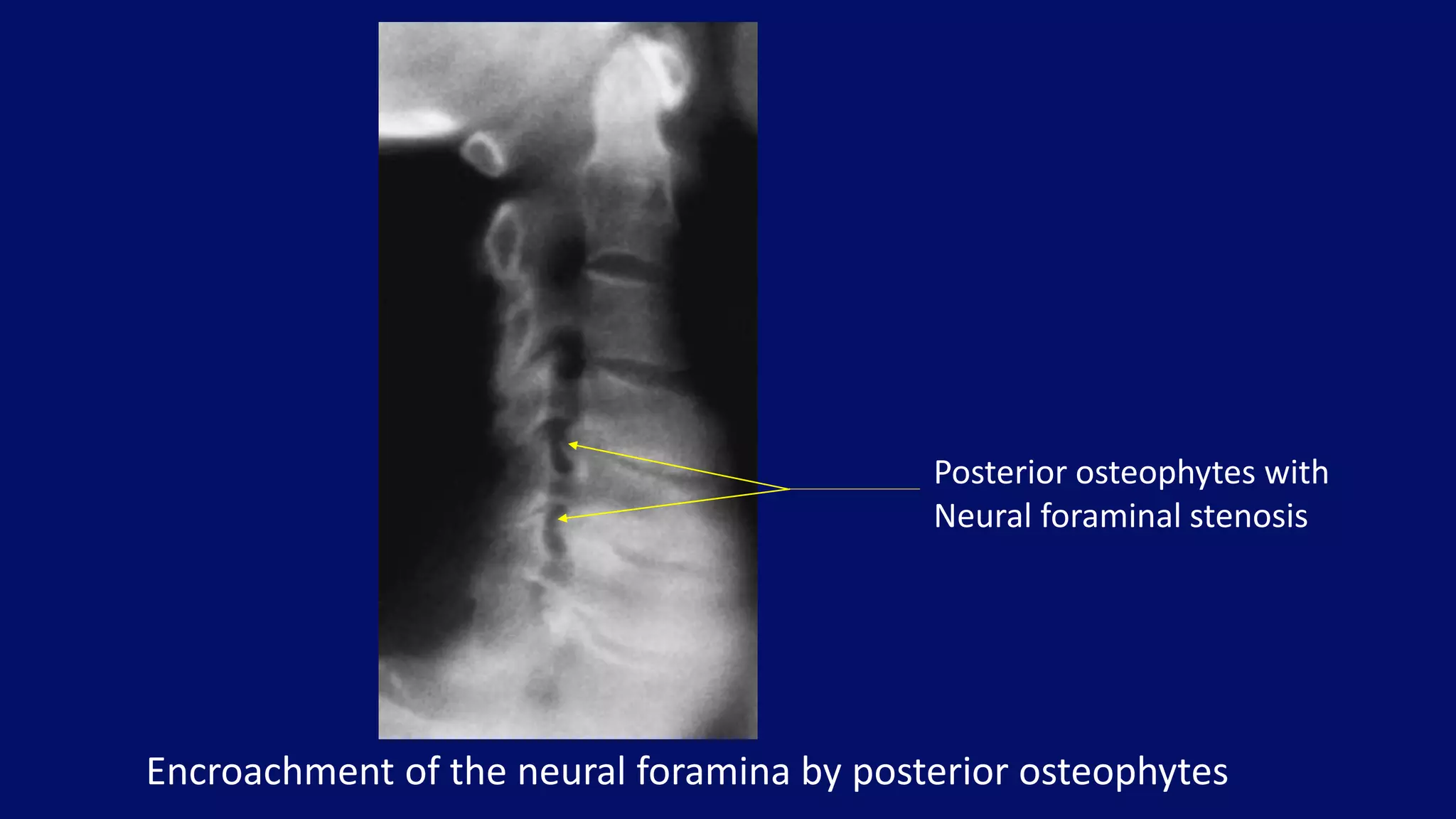 Encroachment of the neural foramina by posterior osteophytes
Posterior osteophytes with
Neural foraminal stenosis
 