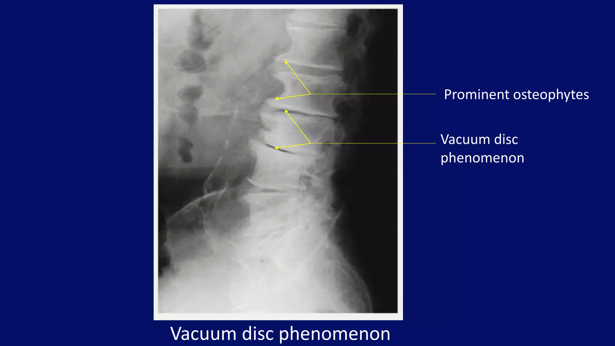 Vacuum disc phenomenon
Prominent osteophytes
Vacuum disc
phenomenon
 
