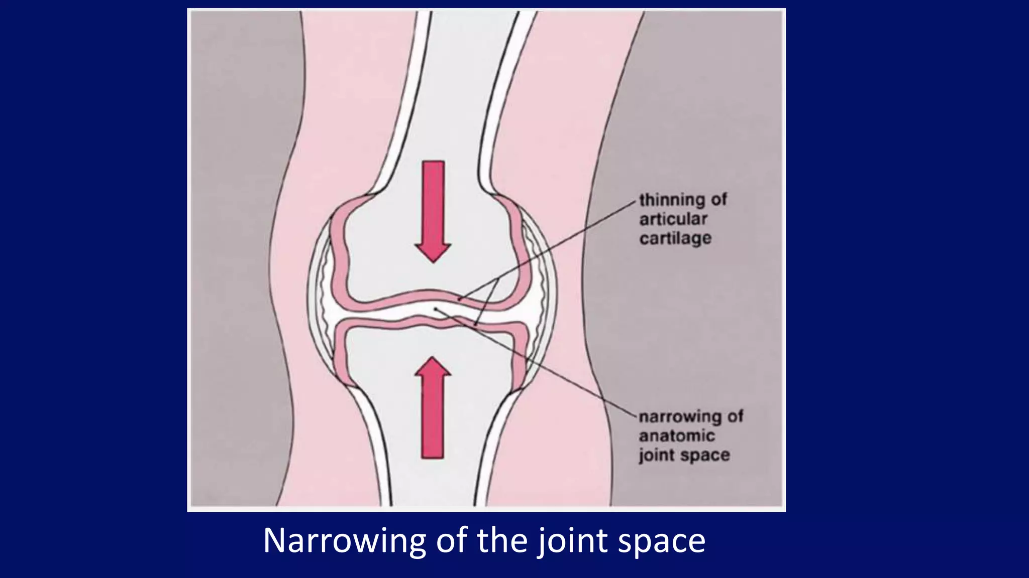 Narrowing of the joint space
 