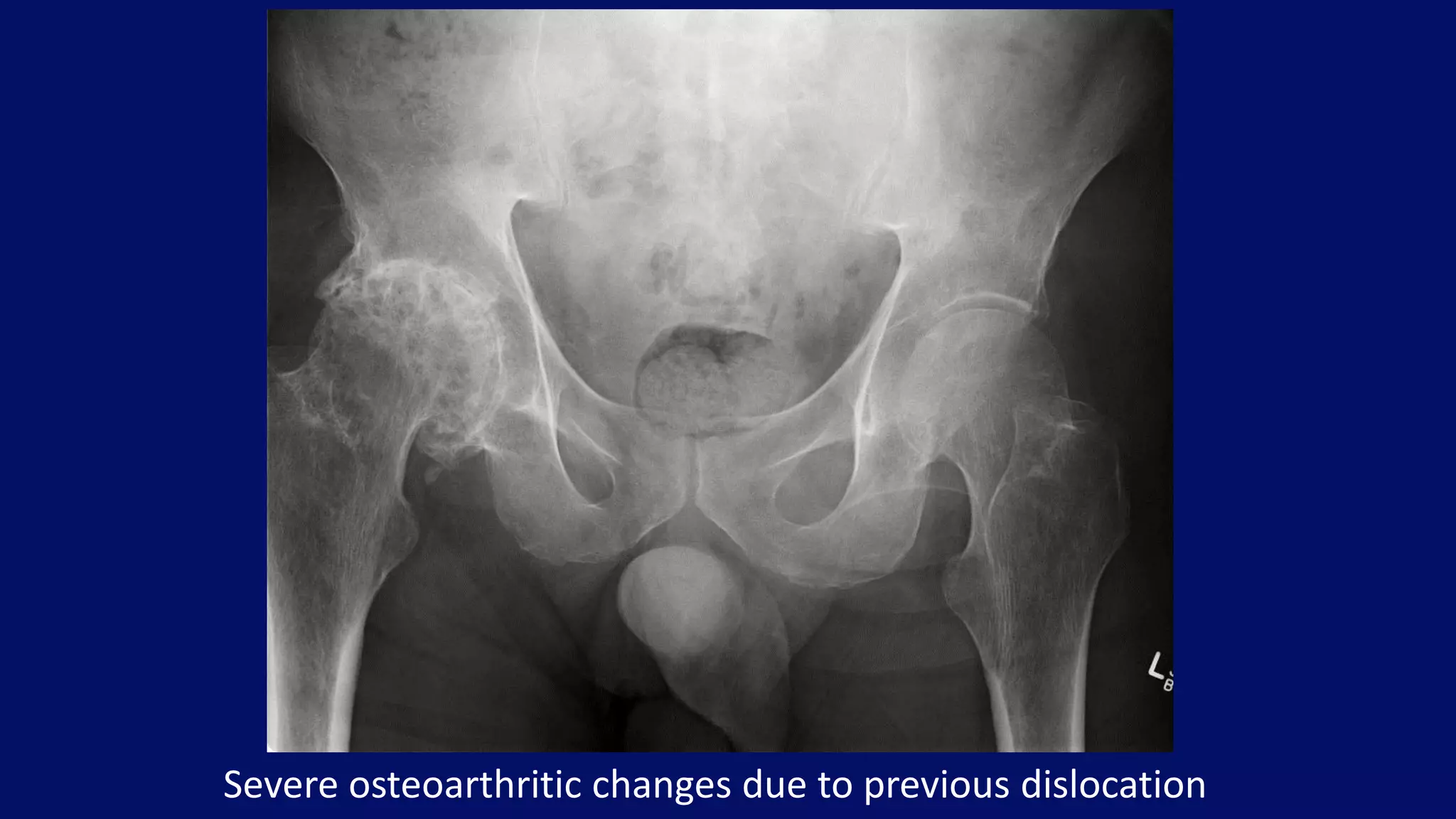Severe osteoarthritic changes due to previous dislocation
 