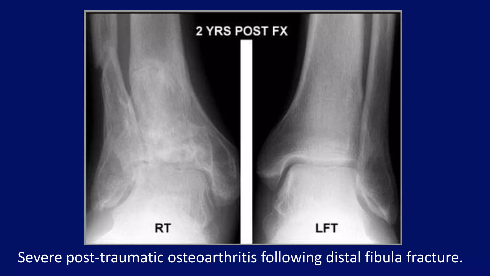 Severe post-traumatic osteoarthritis following distal fibula fracture.
 