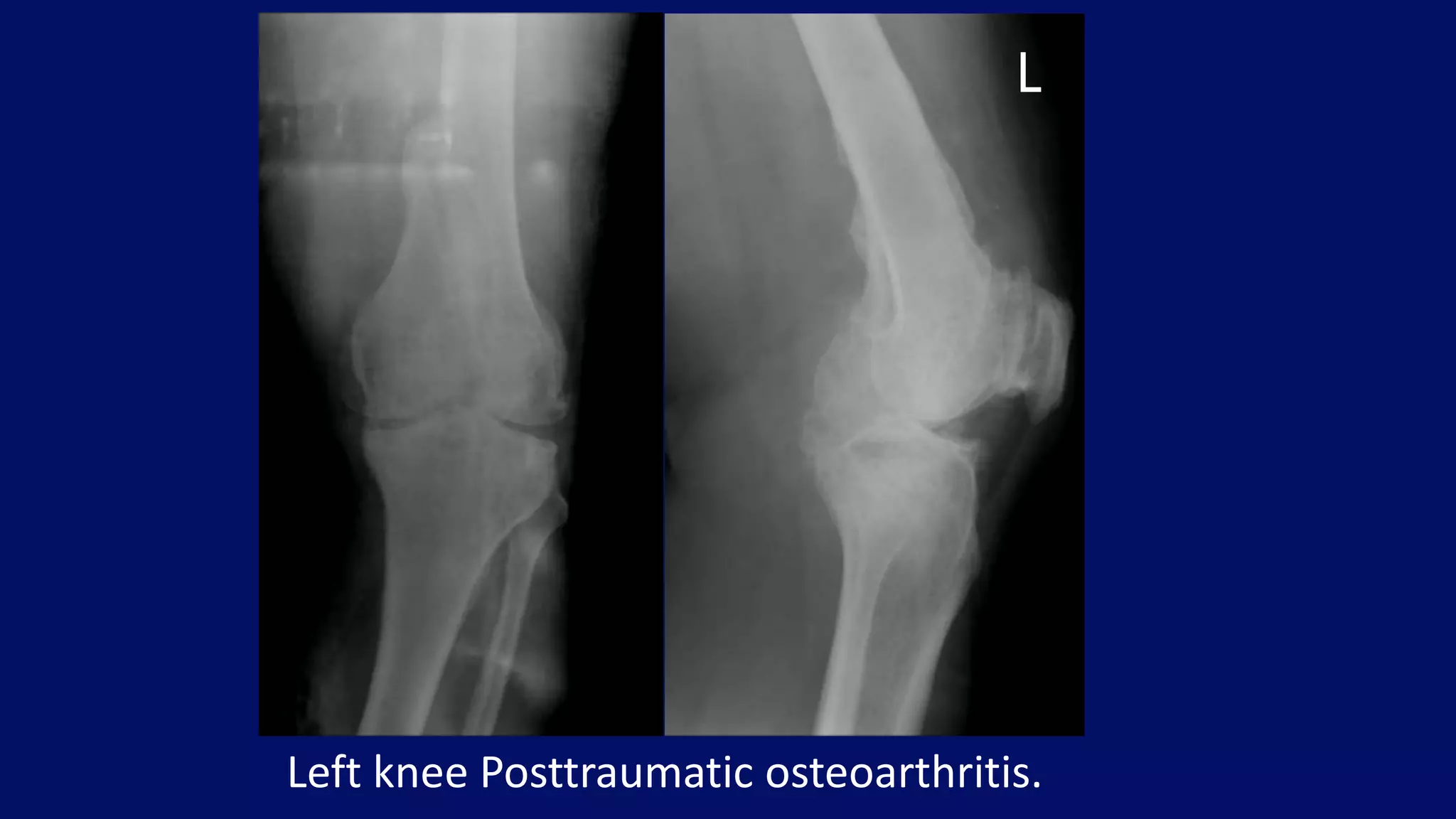 Left knee Posttraumatic osteoarthritis.
L
 