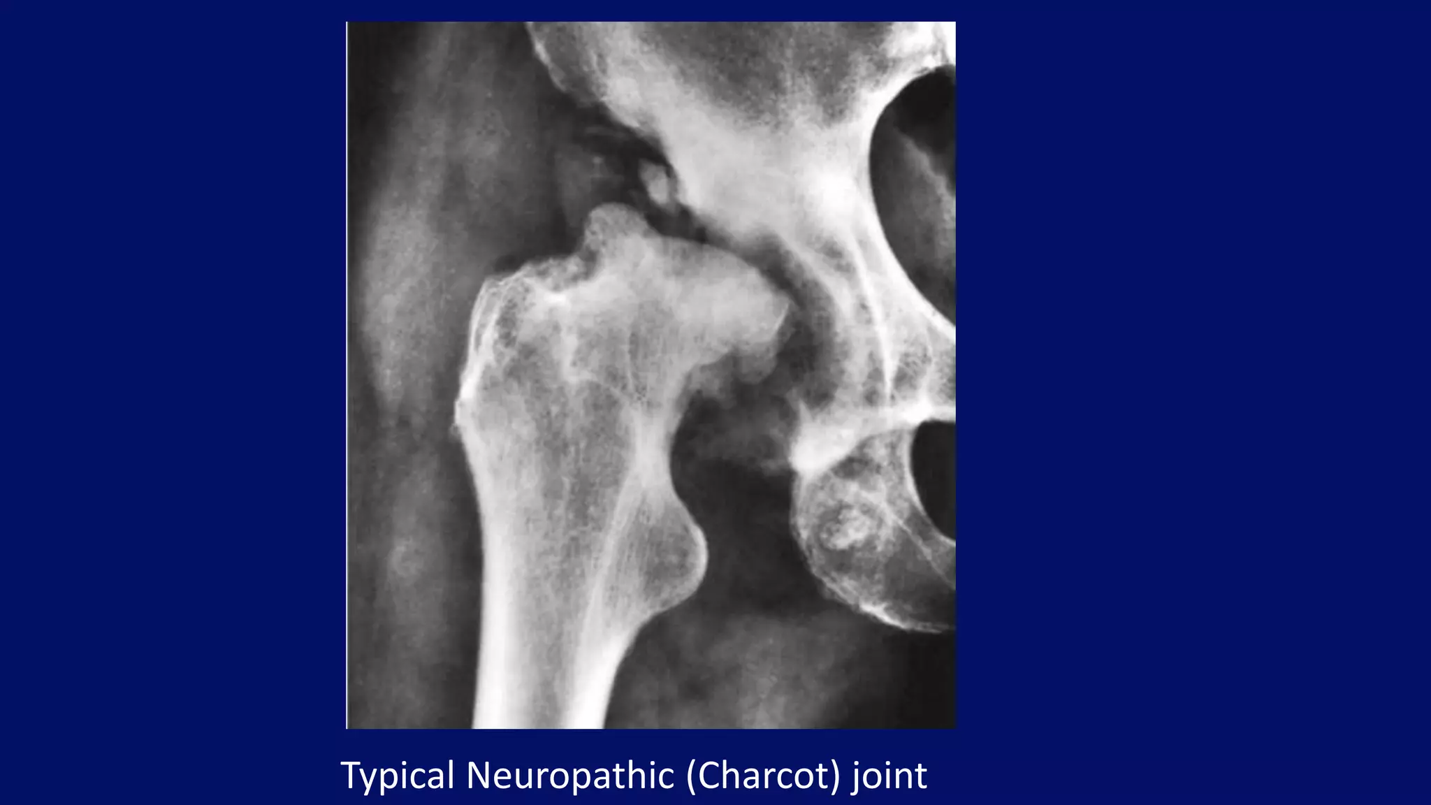 Typical Neuropathic (Charcot) joint
 