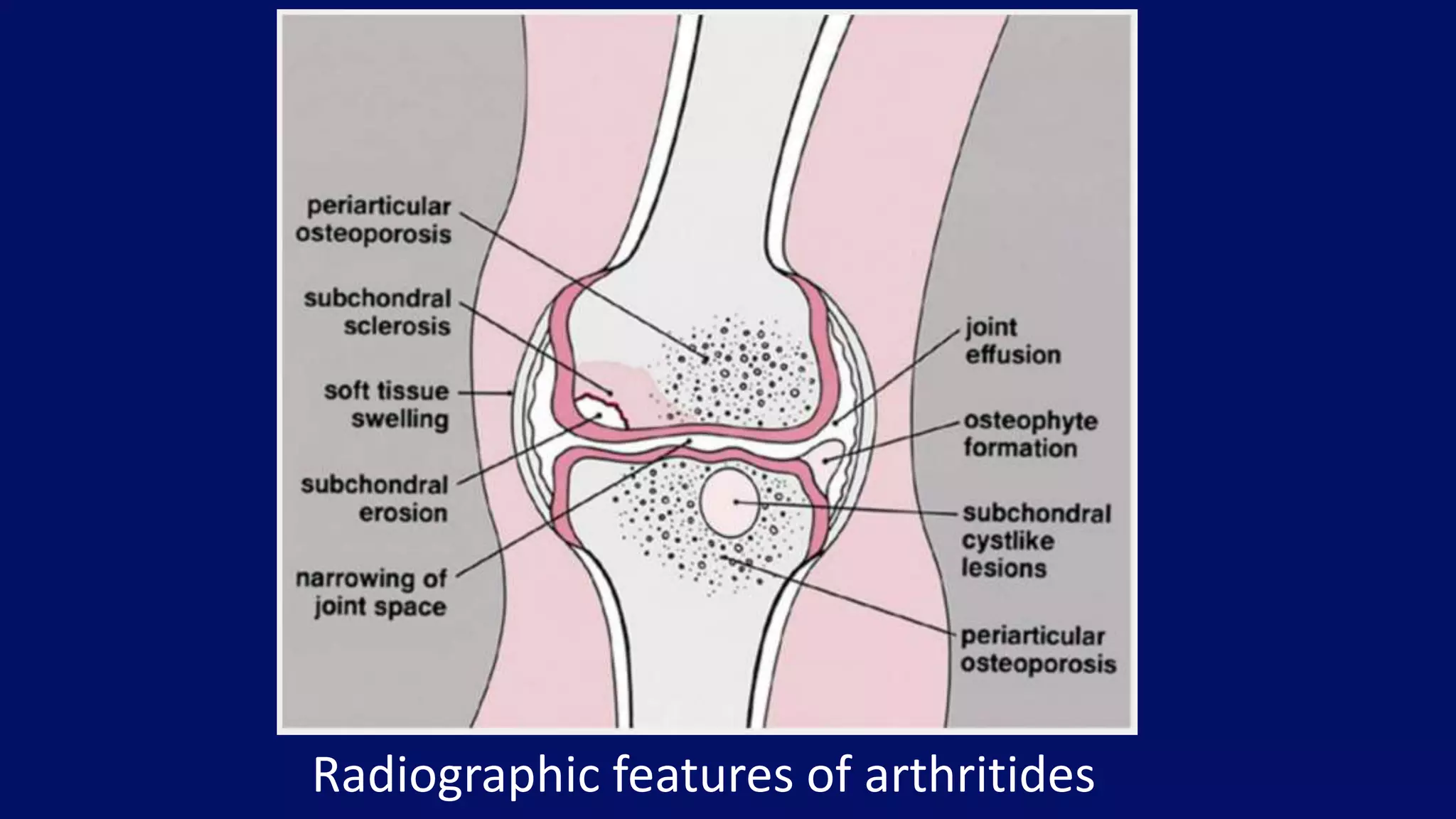 Radiographic features of arthritides
 