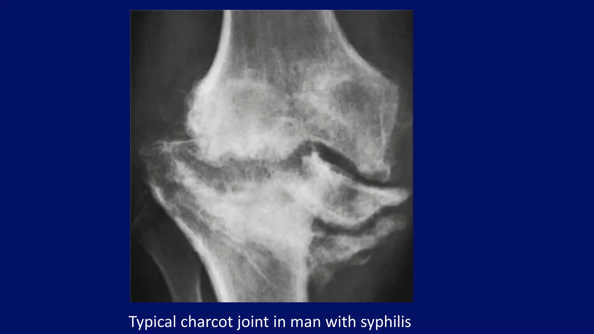 Typical charcot joint in man with syphilis
 