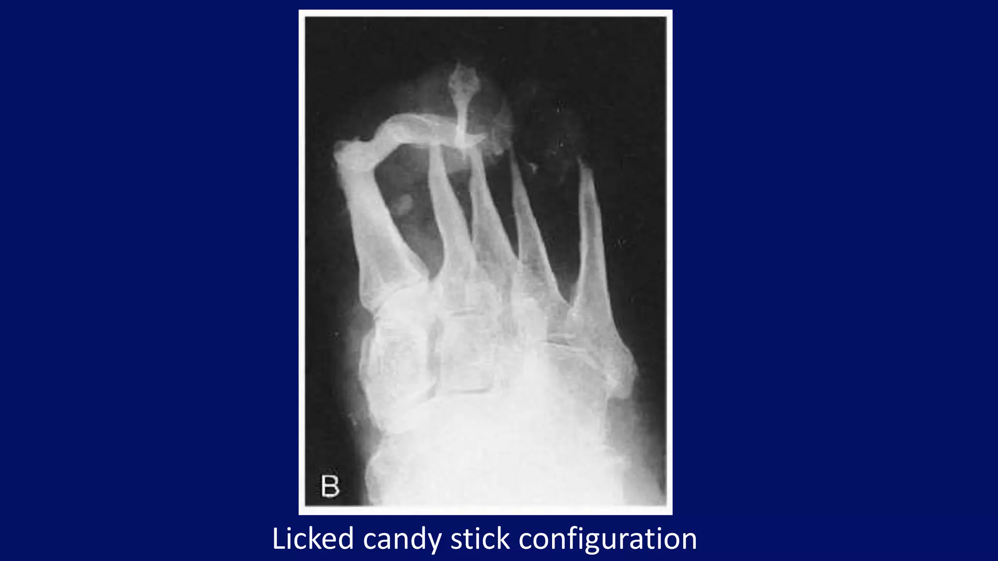 Licked candy stick configuration
 
