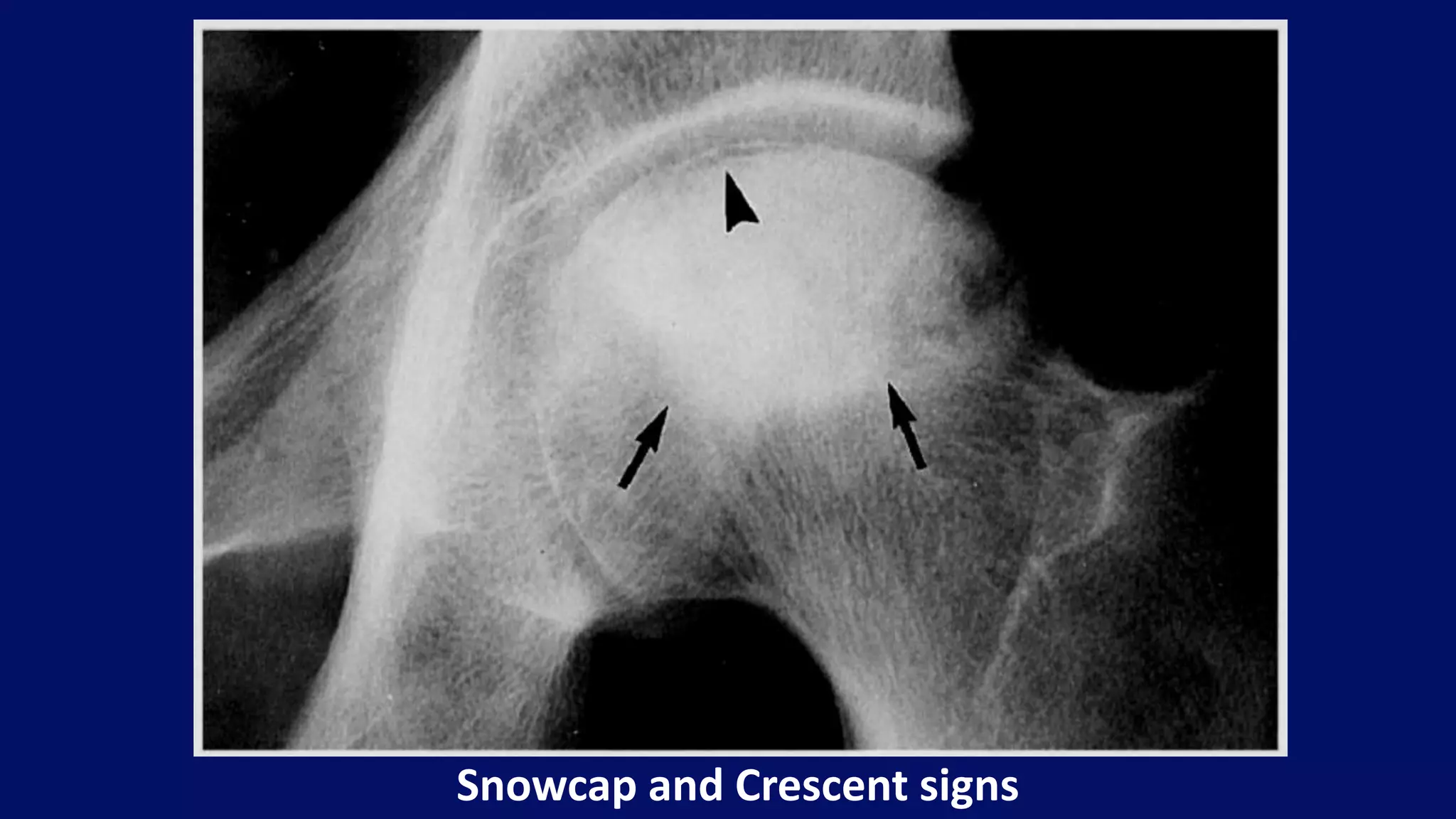Snowcap and Crescent signs
 