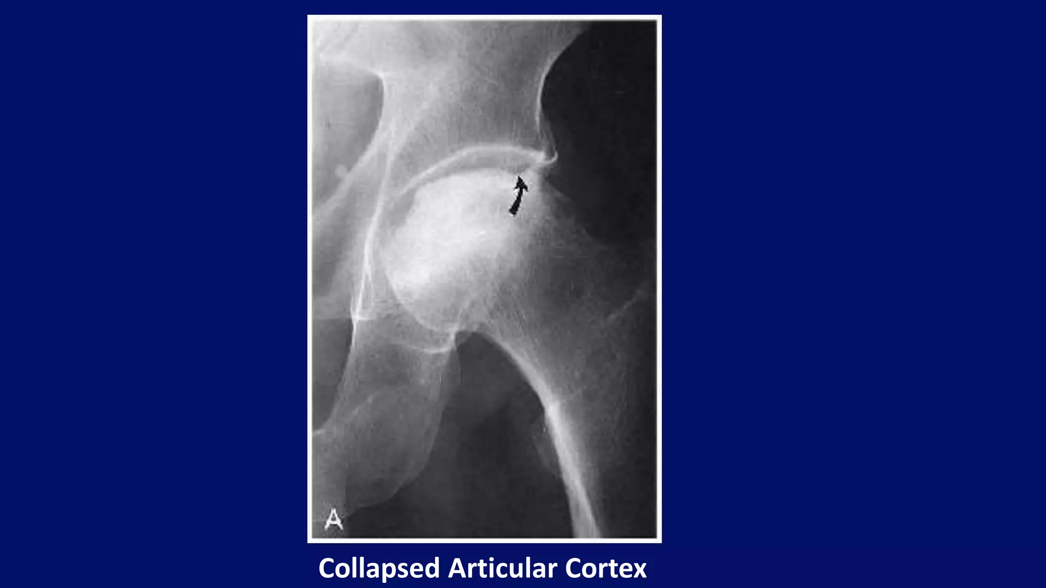 Collapsed Articular Cortex
 