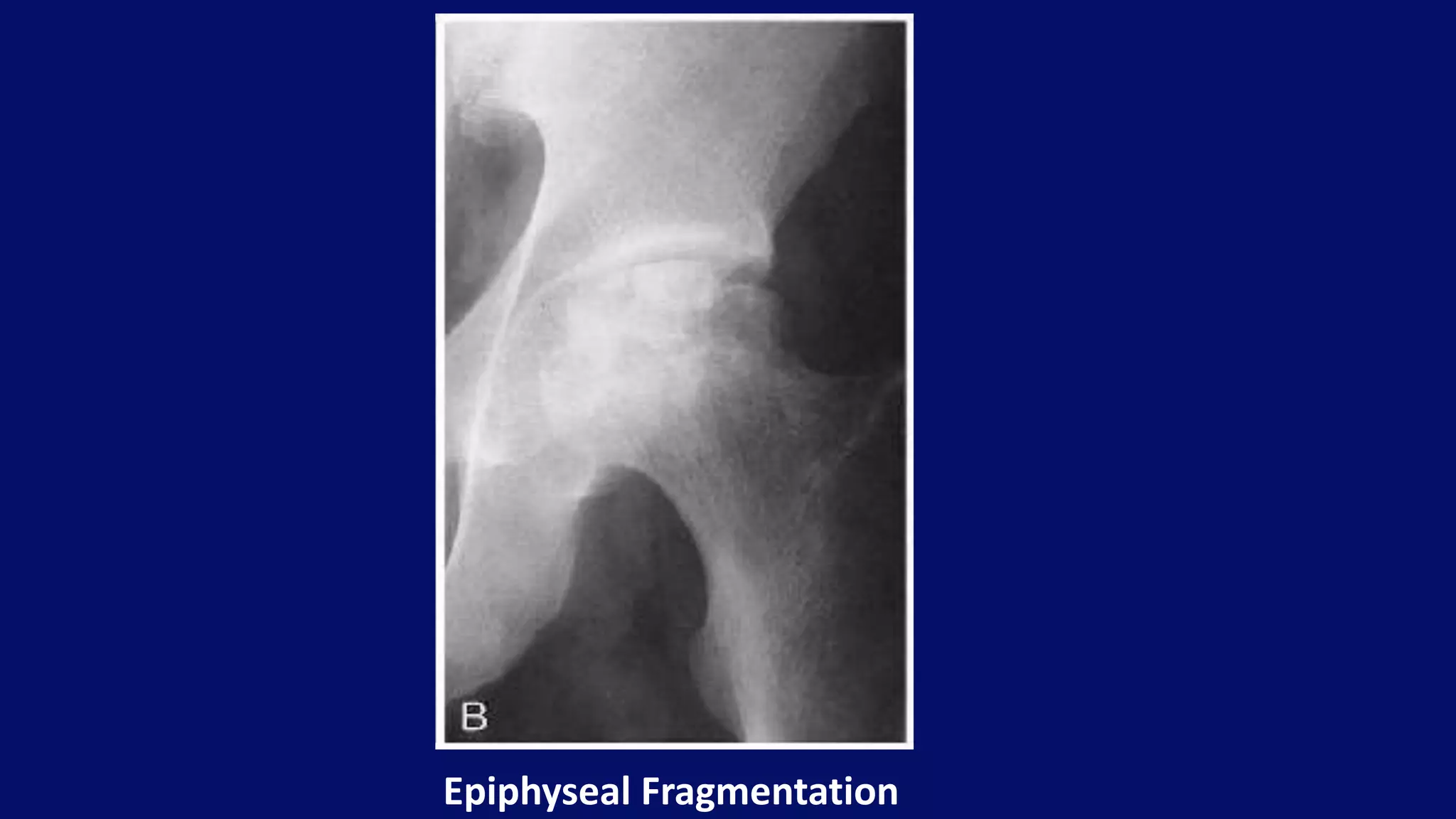 Epiphyseal Fragmentation
 