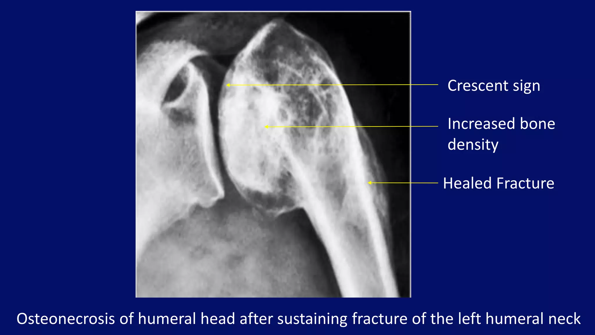 Osteonecrosis of humeral head after sustaining fracture of the left humeral neck
Crescent sign
Increased bone
density
Healed Fracture
 