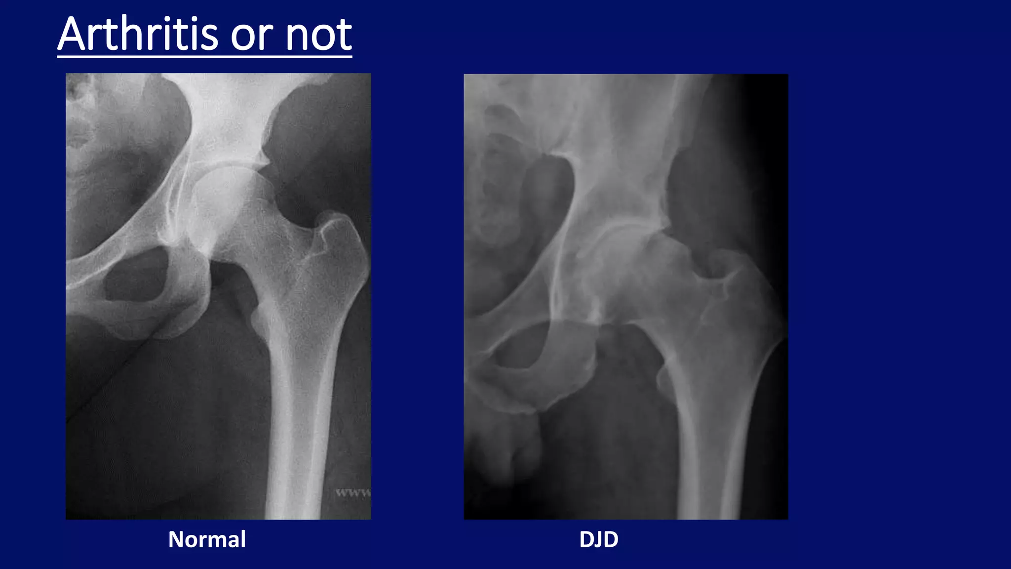 Arthritis or not
Normal DJD
 