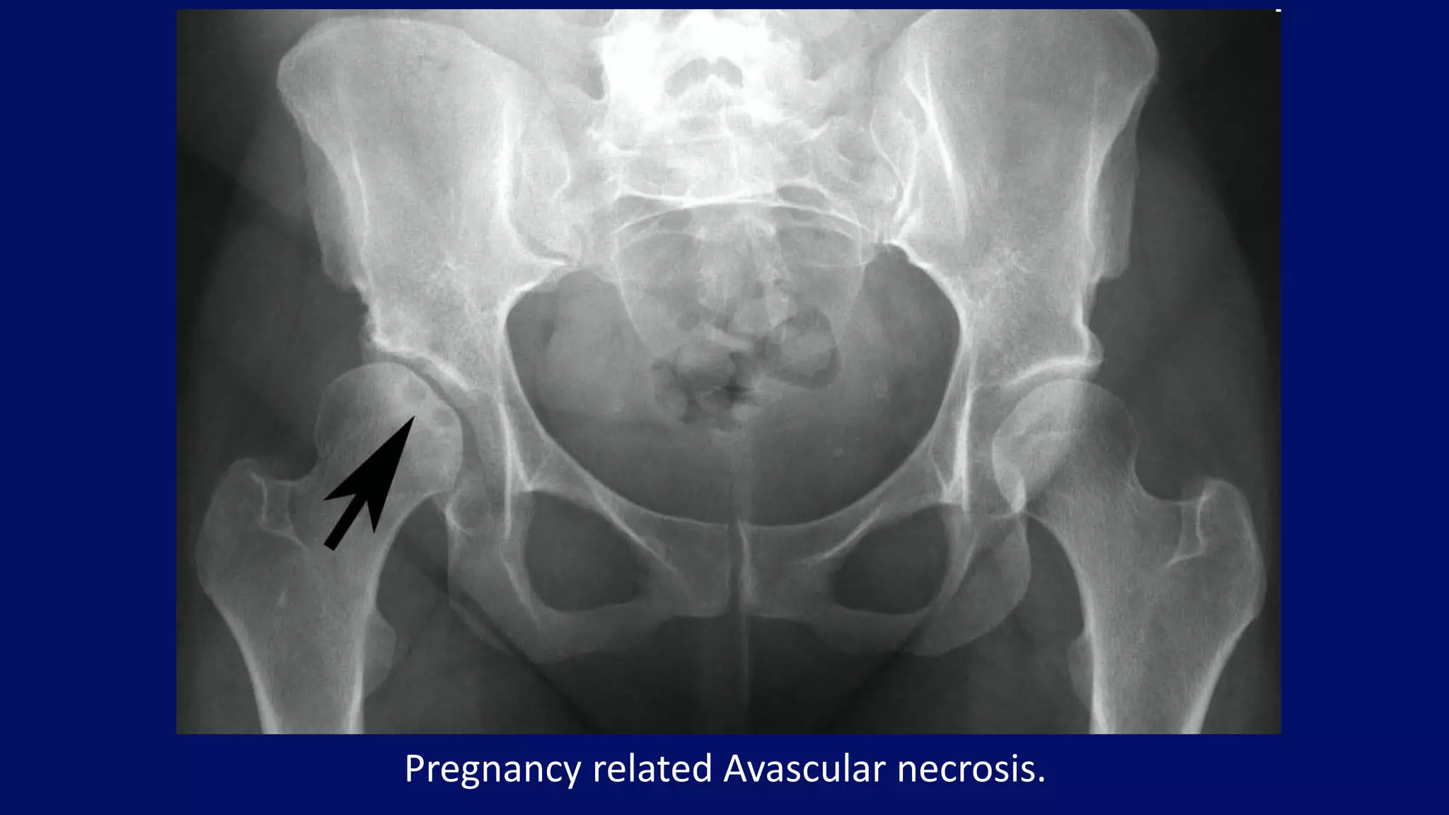 Pregnancy related Avascular necrosis.
 
