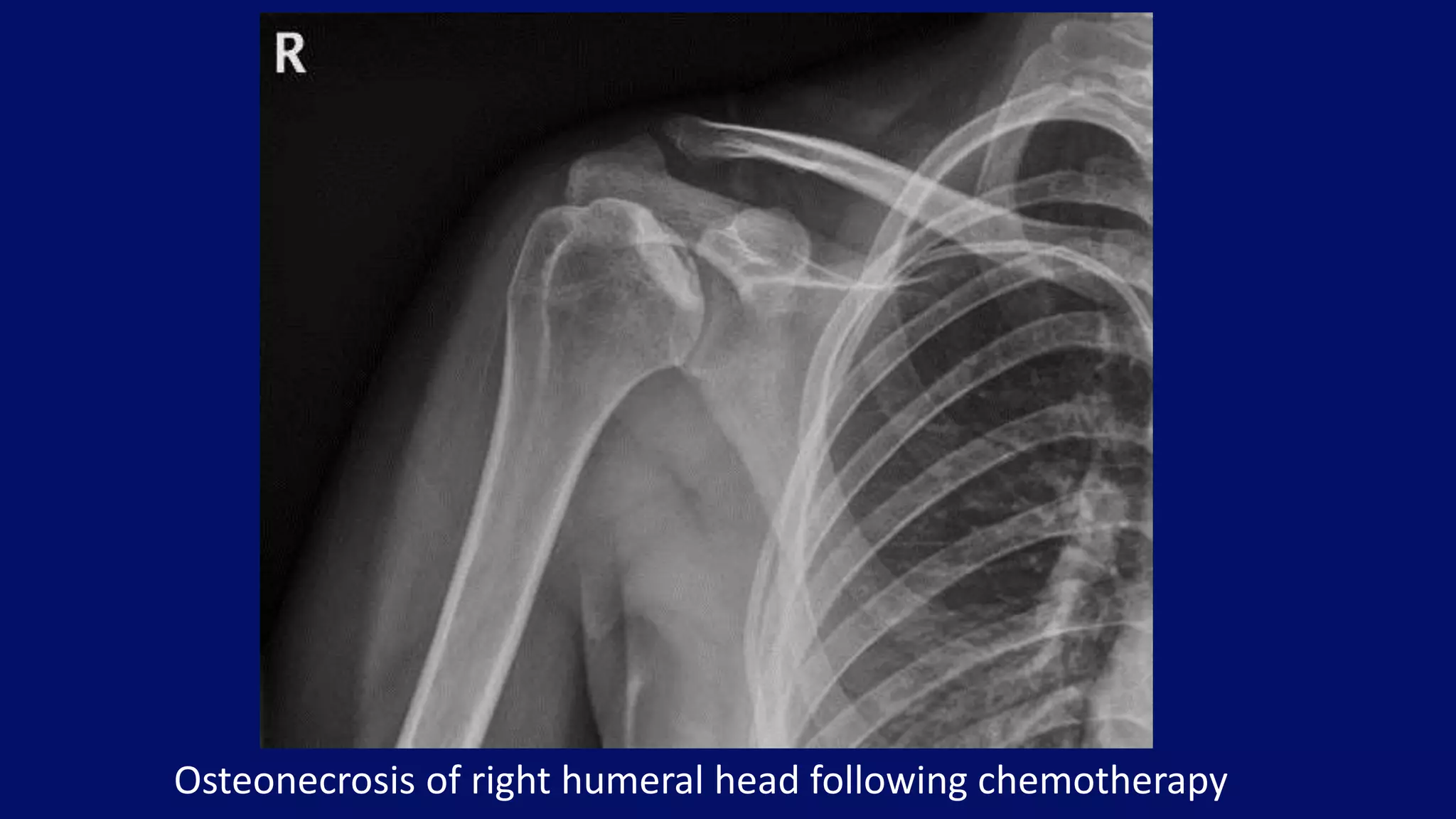 Osteonecrosis of right humeral head following chemotherapy
 