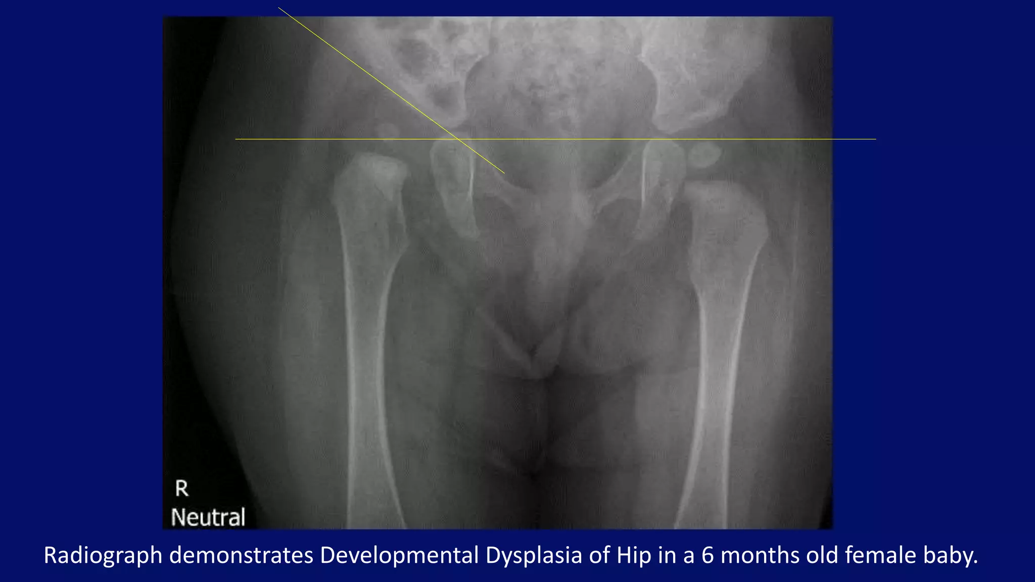 Radiograph demonstrates Developmental Dysplasia of Hip in a 6 months old female baby.
 