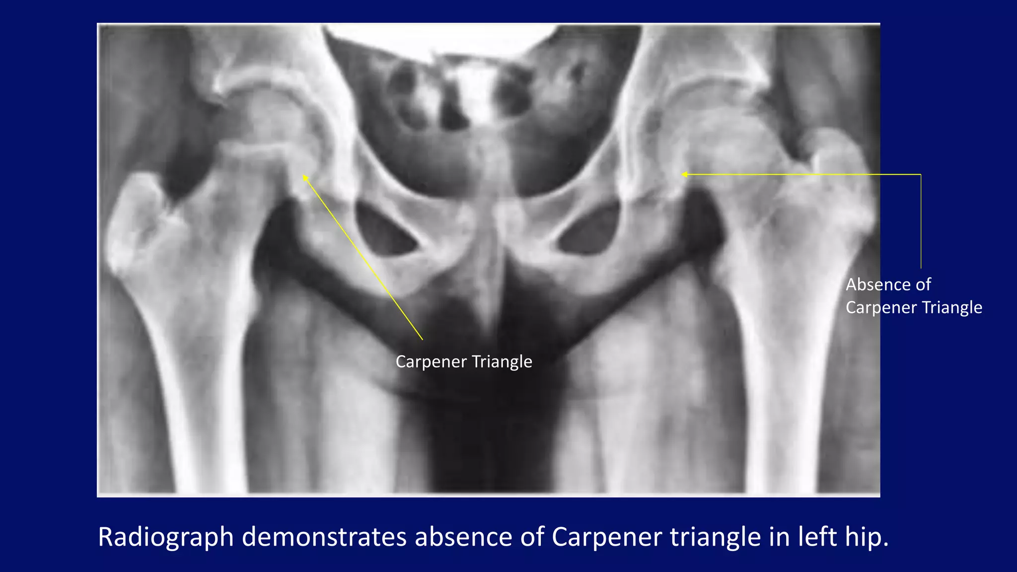 Radiograph demonstrates absence of Carpener triangle in left hip.
Carpener Triangle
Absence of
Carpener Triangle
 