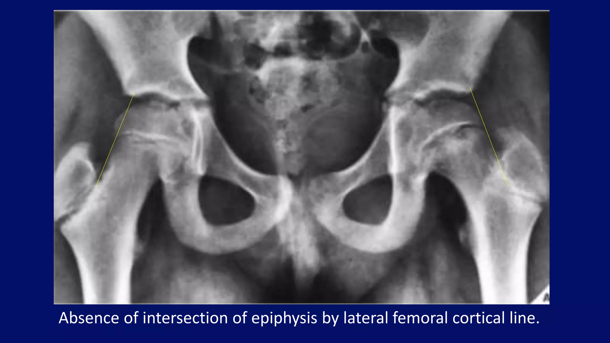 Absence of intersection of epiphysis by lateral femoral cortical line.
 