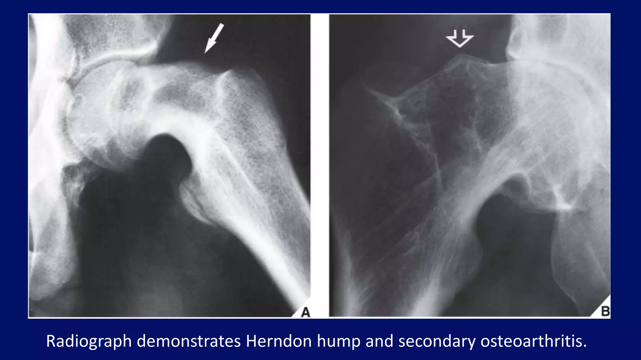 Radiograph demonstrates Herndon hump and secondary osteoarthritis.
 
