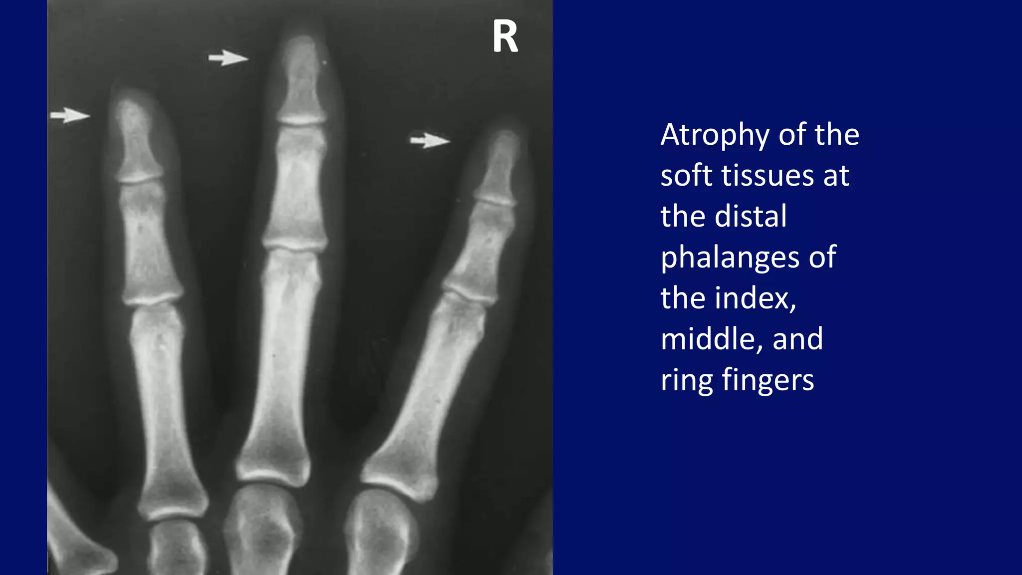 Atrophy of the
soft tissues at
the distal
phalanges of
the index,
middle, and
ring fingers
R
 