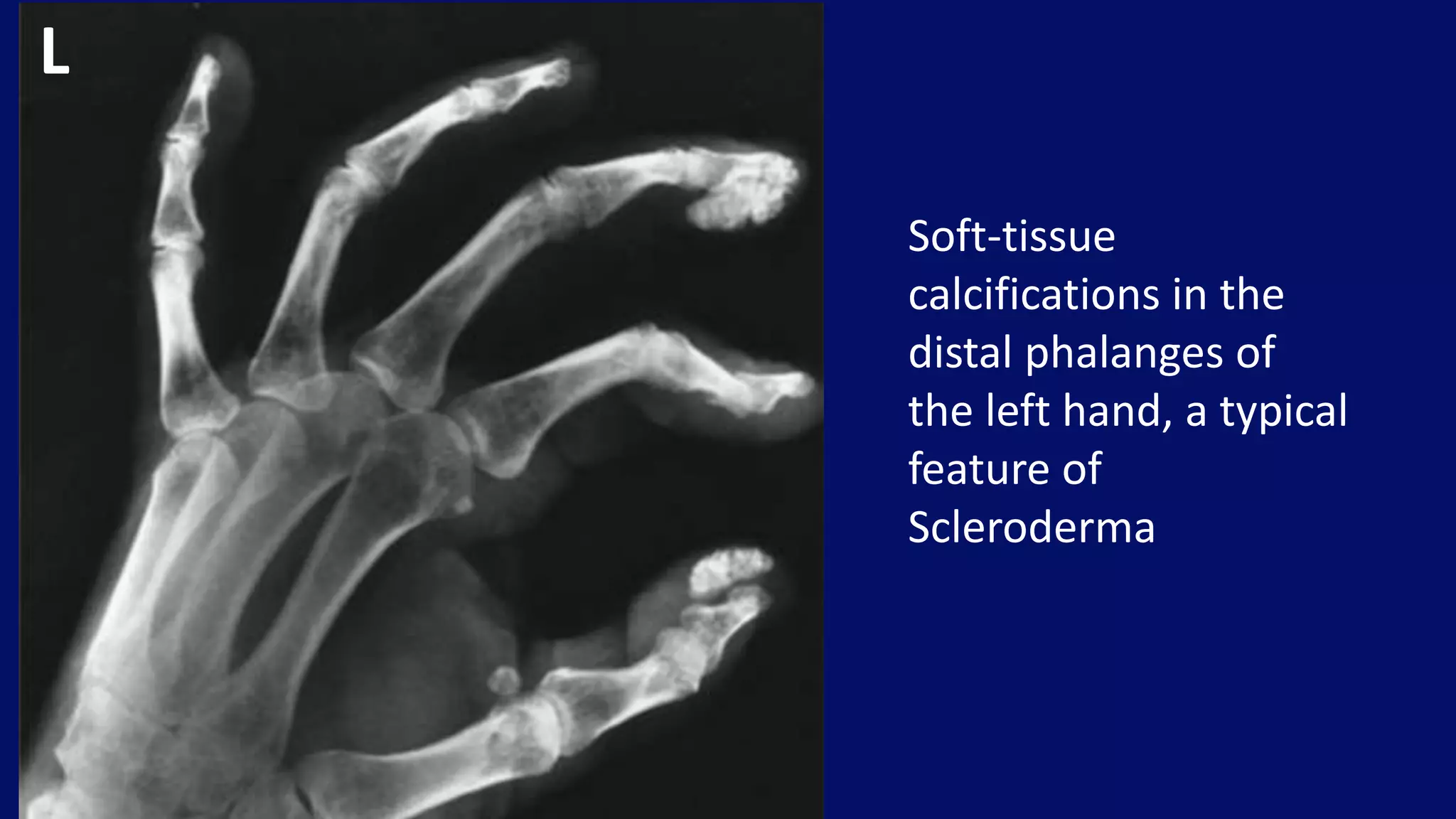 Soft-tissue
calcifications in the
distal phalanges of
the left hand, a typical
feature of
Scleroderma
L
 