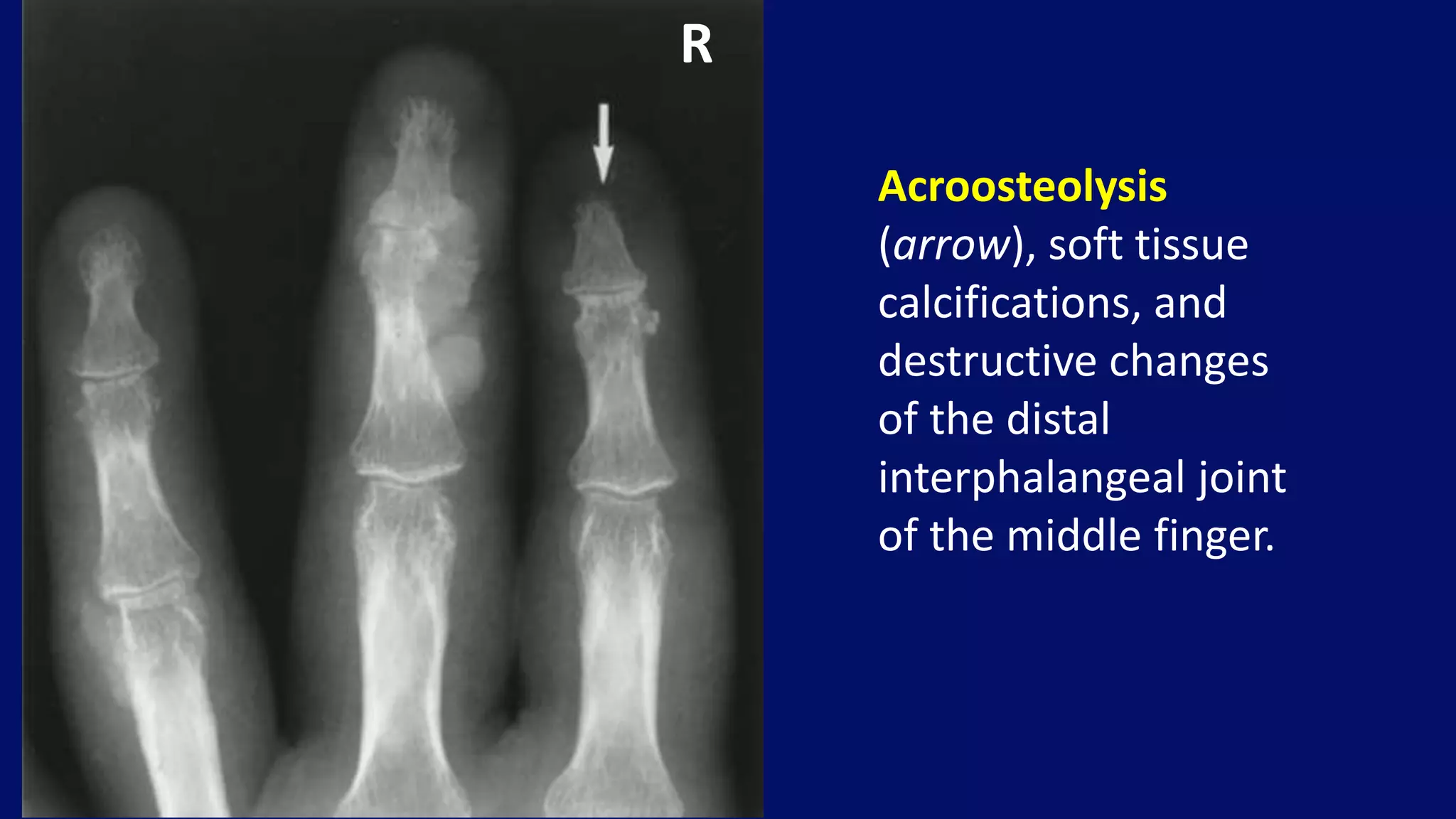 Acroosteolysis
(arrow), soft tissue
calcifications, and
destructive changes
of the distal
interphalangeal joint
of the middle finger.
R
 