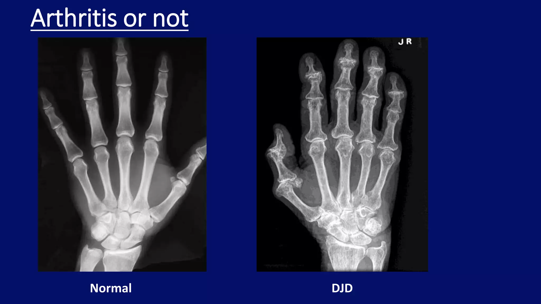 Arthritis or not
Normal DJD
 