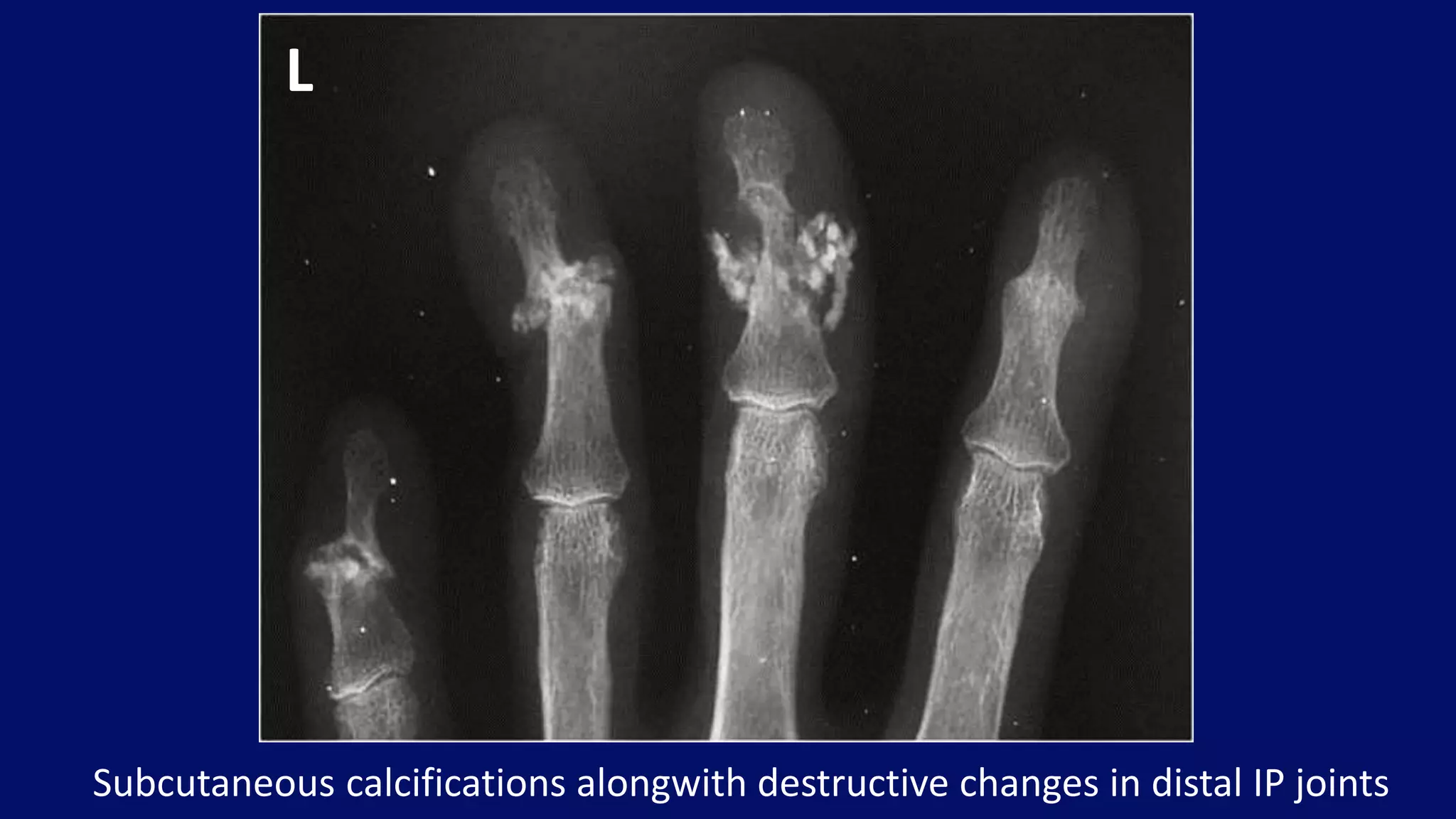Subcutaneous calcifications alongwith destructive changes in distal IP joints
L
 
