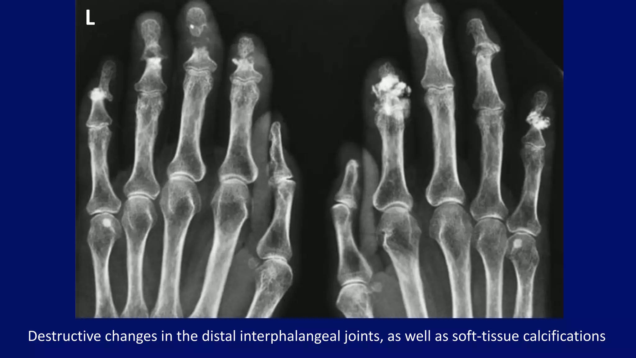 Destructive changes in the distal interphalangeal joints, as well as soft-tissue calcifications
L
 