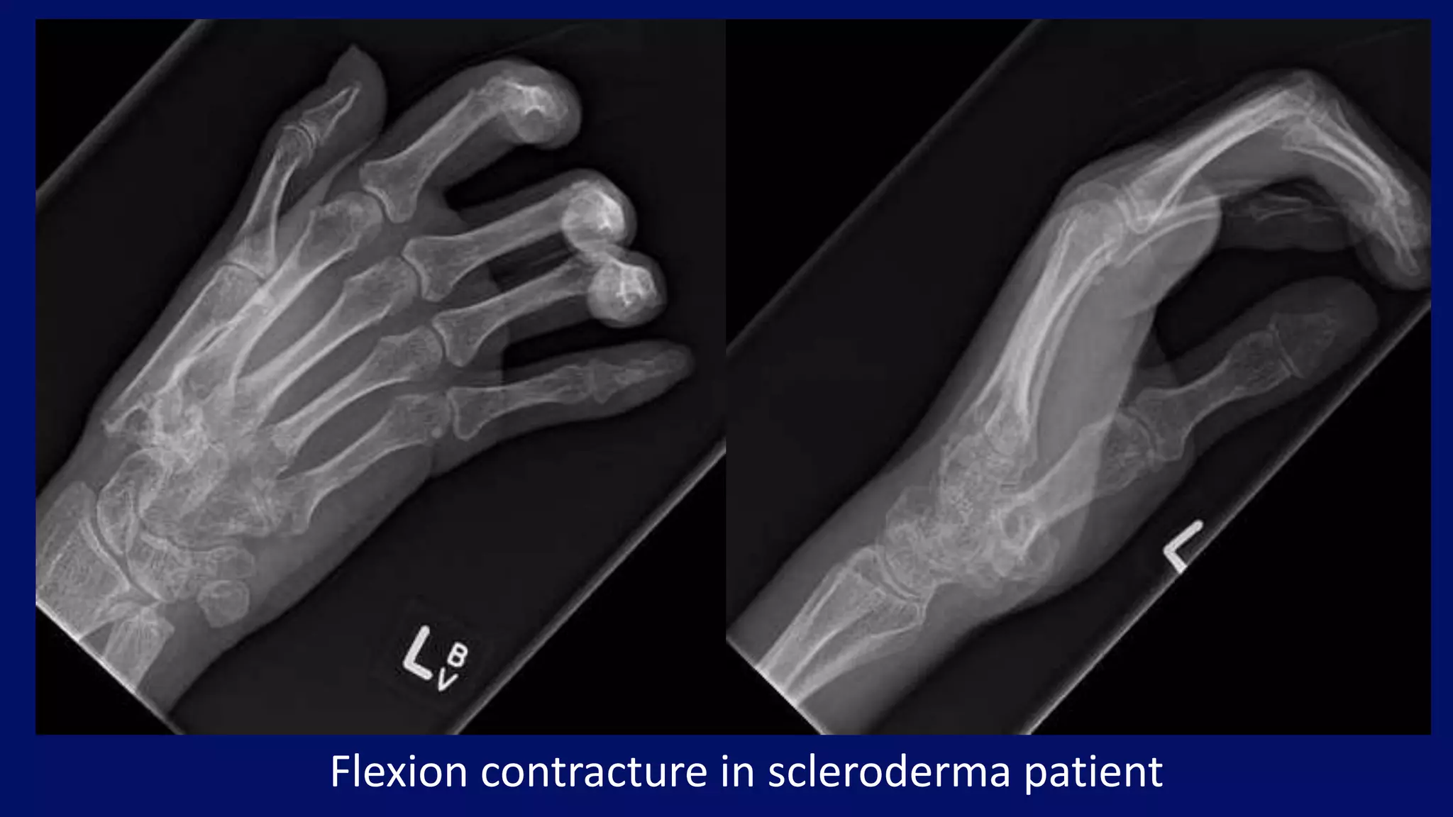Flexion contracture in scleroderma patient
 