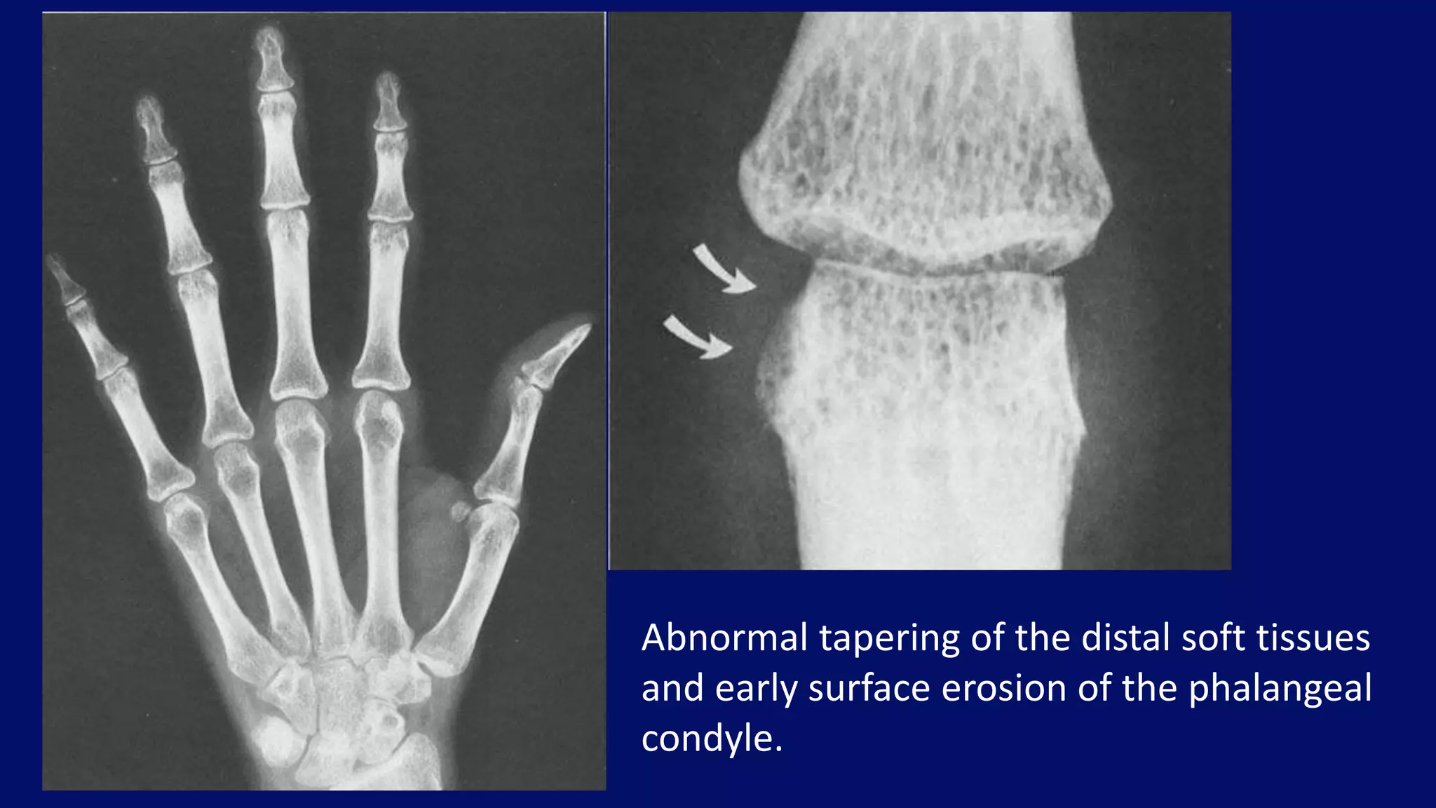 Abnormal tapering of the distal soft tissues
and early surface erosion of the phalangeal
condyle.
 