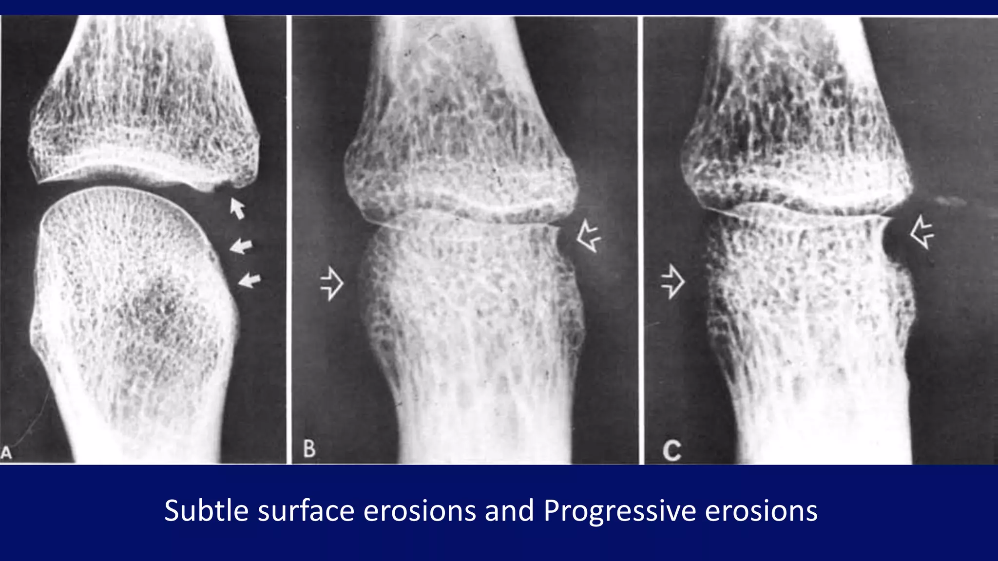 Subtle surface erosions and Progressive erosions
 