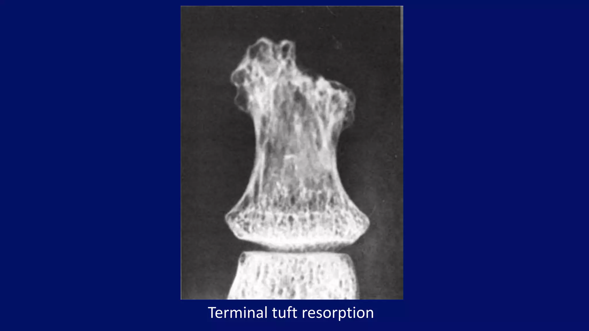Terminal tuft resorption
 