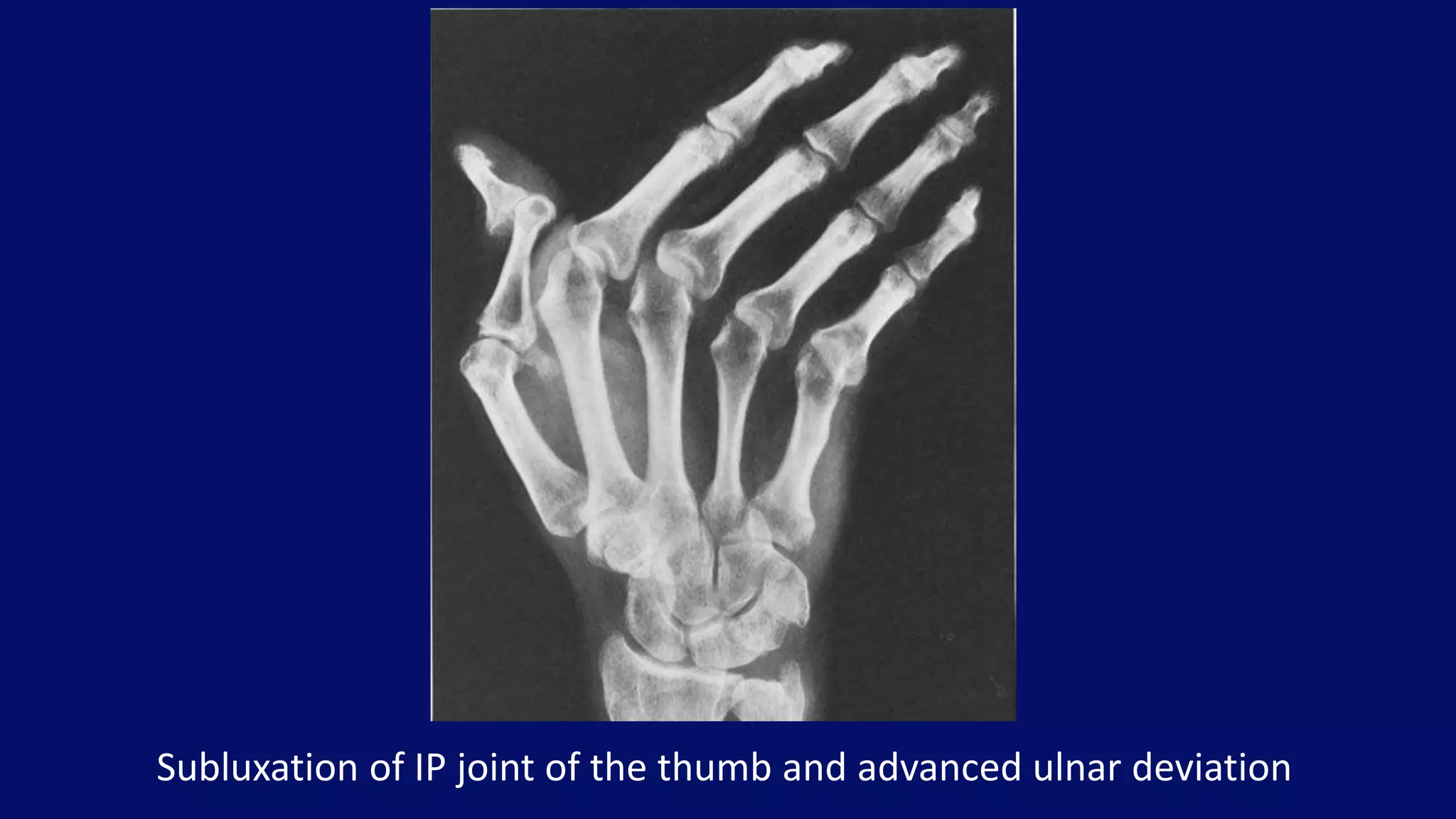 Subluxation of IP joint of the thumb and advanced ulnar deviation
 