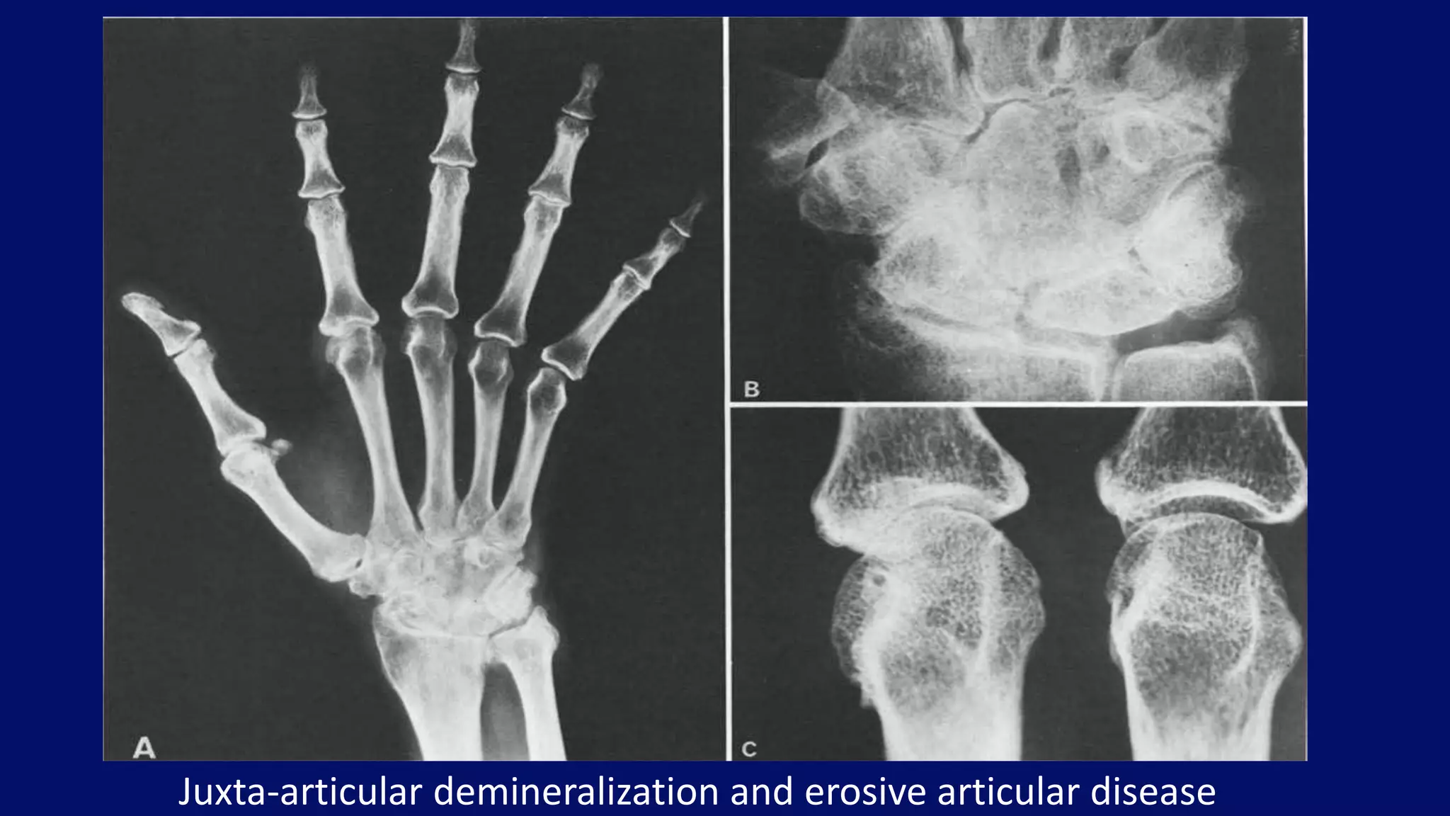 Juxta-articular demineralization and erosive articular disease
 