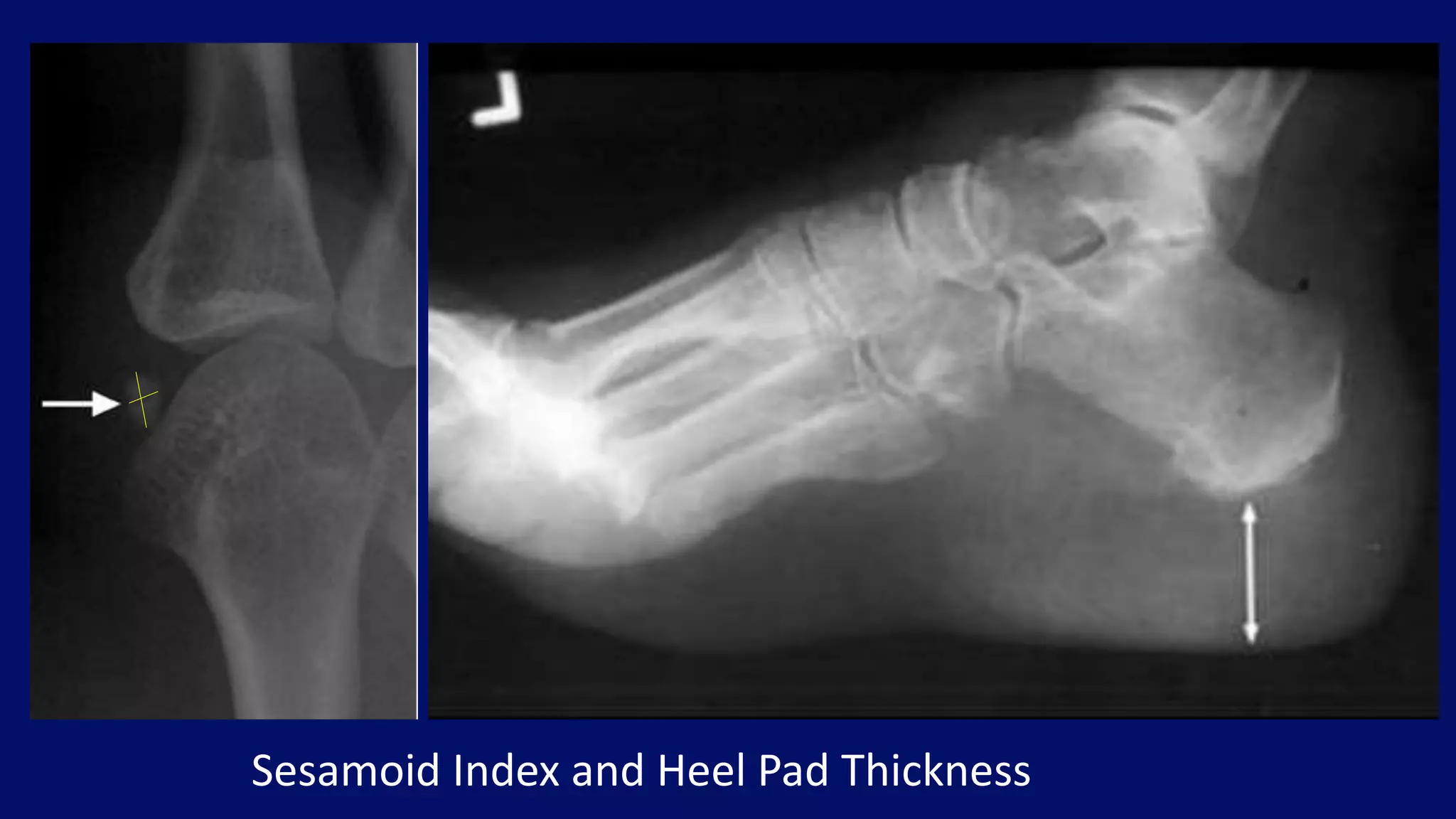 Sesamoid Index and Heel Pad Thickness
 