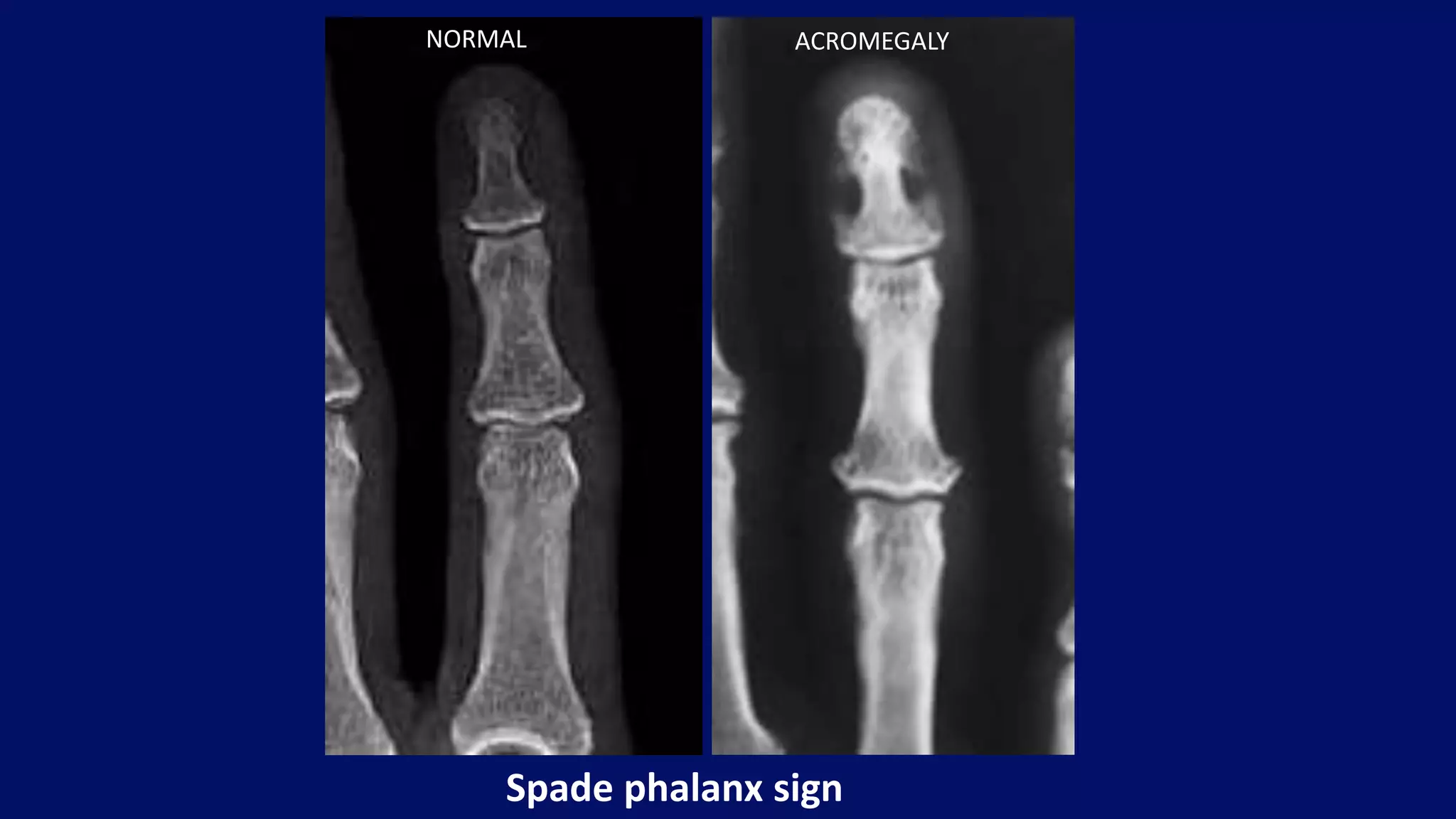 Spade phalanx sign
NORMAL ACROMEGALY
 