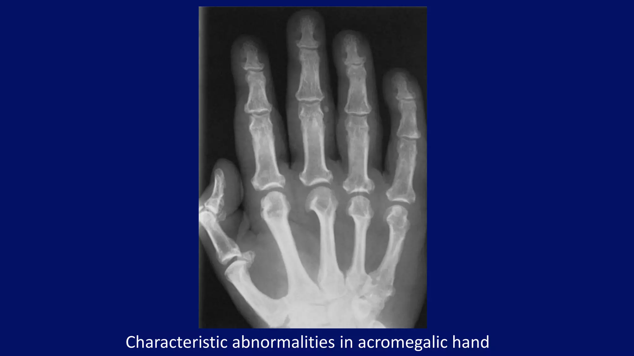 Characteristic abnormalities in acromegalic hand
 