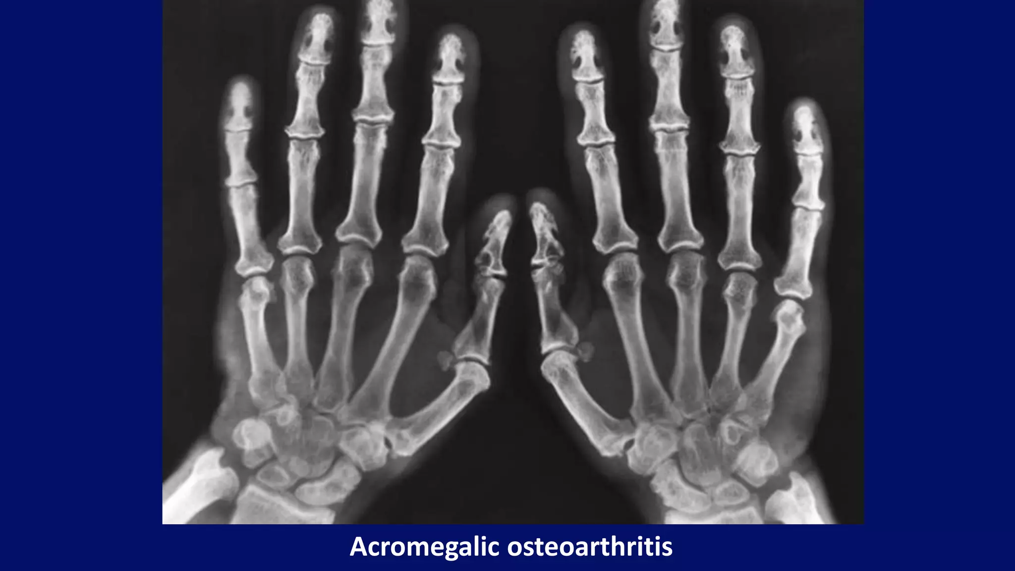 Acromegalic osteoarthritis
 