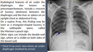 Triangular Sign Chest XRAY Interpretation for medical students | PPTX