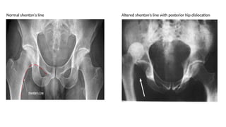 X ray of the hip bones. clinical points for these. | PPTX