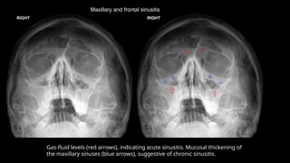 Maxillary and frontal sinusitis
Gas-fluid levels (red arrows), indicating acute sinusitis. Mucosal thickening of
the maxillary sinuses (blue arrows), suggestive of chronic sinusitis.
 