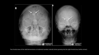 Two frontal views of the skull demonstrate an incidental rounded, sclerotic lesion growing into the right frontal sinus (white arrows).
 