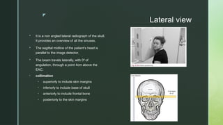 z
Lateral view
 It is a non angled lateral radiograph of the skull.
It provides an overview of all the sinuses.
 The sagittal midline of the patient’s head is
parallel to the image detector.
 The beam travels laterally, with 0 of
⁰
angulation, through a point 4cm above the
EAC.
• collimation
• superiorly to include skin margins
• inferiorly to include base of skull
• anteriorly to include frontal bone
• posteriorly to the skin margins
 