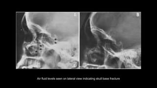 Air fluid levels seen on lateral view indicating skull base fracture
 